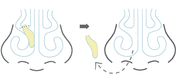 鼻茸摘出術を説明したイラスト